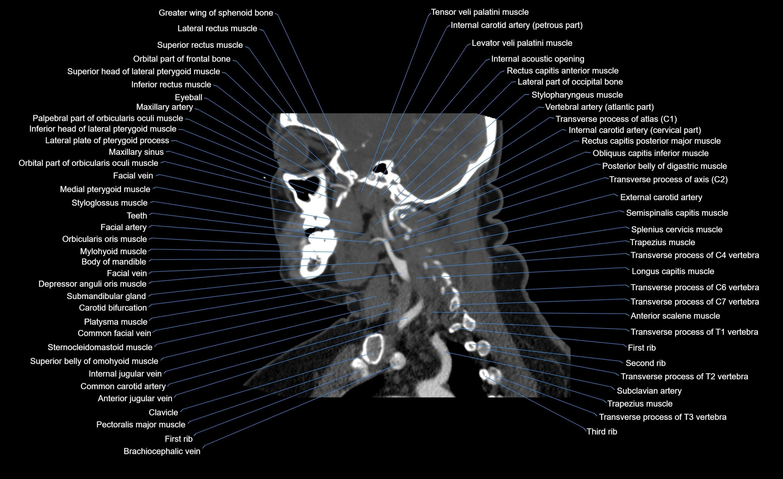 Neck CT sagittal cross sectional anatomy 3D  radiology  image-img-00001-00010.webp